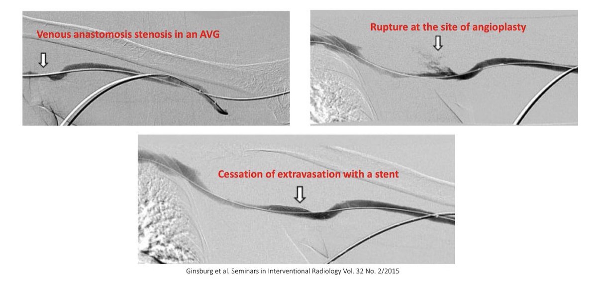 Rupture of the vessel can occur during angioplasty of a severely stenotic lesionIn most cases, extravasation can be controlled w/ manual compression or balloon tamponade but if bleeding persists then stents can be used to control the bleeding 10/