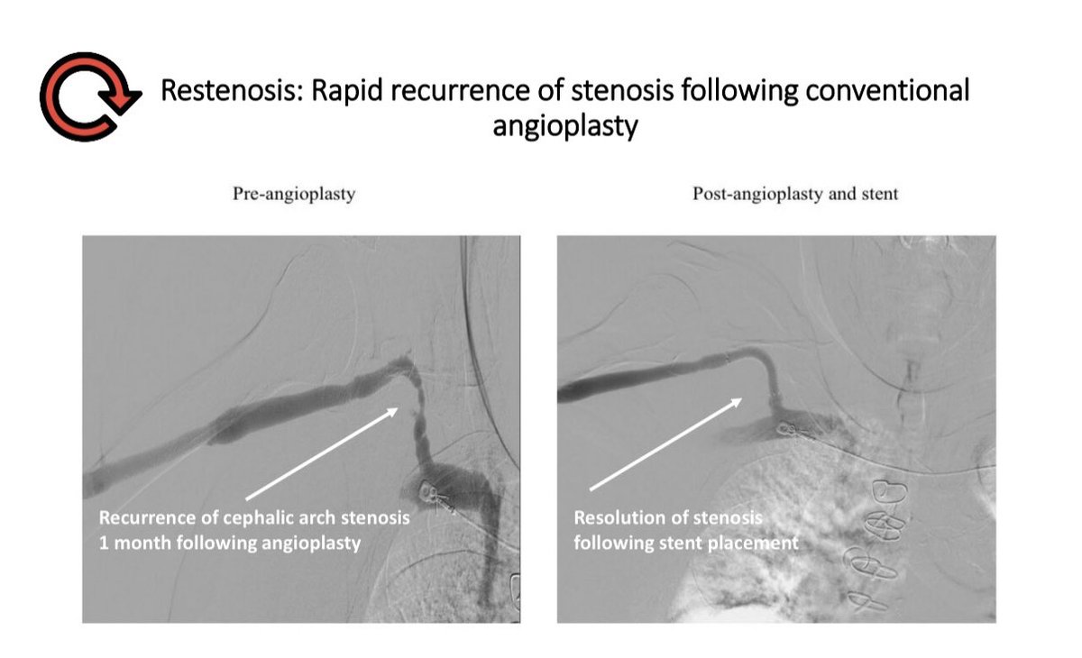 Restenosis is the most common indication for stent useAVG patency post-angioplasty is very poorMost common site for AVG stenosis is at the graft-vein anastomosis, therefore recent clinical trials have tested the Stent-grafts at this site12/