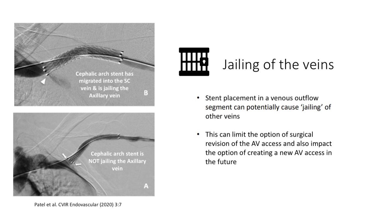 Jailing of the Veins is a complication of stent placement & this can impact future AV access options Hence, the operator must be very careful during stent deployment in order to avoid this complication20/