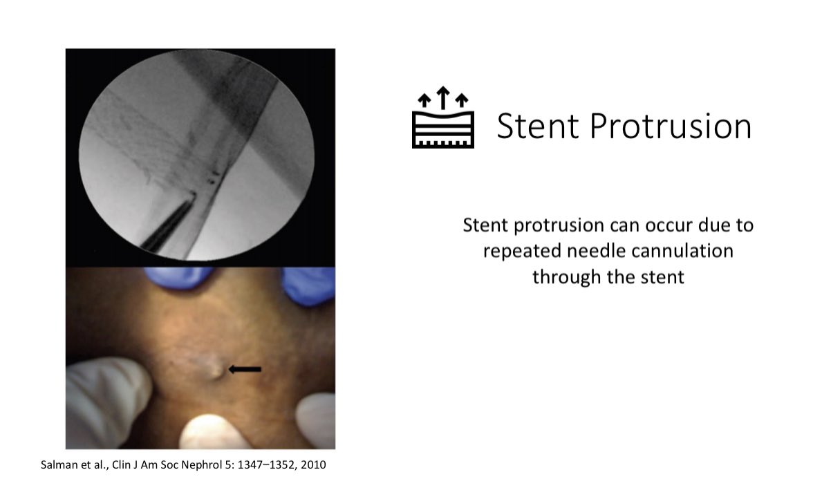 Stent Migration can cause downstream vein occlusion/stenosis & can impact future AV access optionsStent fracture & protrusion can occur due to repeated cannulation thru the stentStent fracture can occur if stent is placed across a joint19/