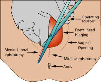 Ok so episiotomy ni apa benda?Bila bersalin normal either kita punya perineum tak koyak, koyak naturally or in some cases Dr. buat episiotomy (potong sikit utk memudahkan baby keluar).I pernah natural tear & epi dan epi jauh lagi uncomfortable n painful lps tu hskshkshsj