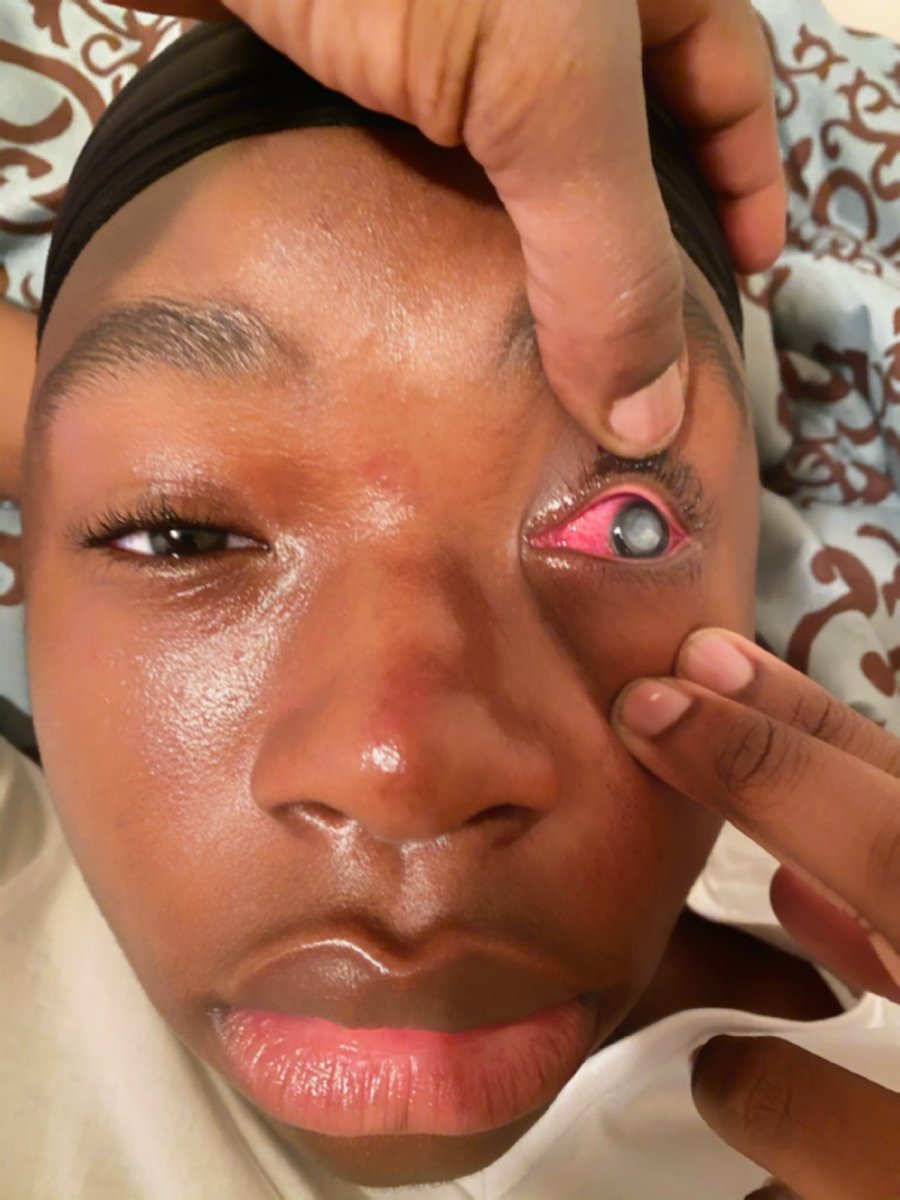 Zoeiana8's tweet photo. EVERYONE PLEASE RETWEET!! My son has lost his vision and has went blind and he needs a transplant. I’m so tired and look a mess but the amount of pain he’s in hurts to my core. He’s my only baby!! We’ve all been through it I’m just begging for awareness atp https://t.co/WDaPHndZGX