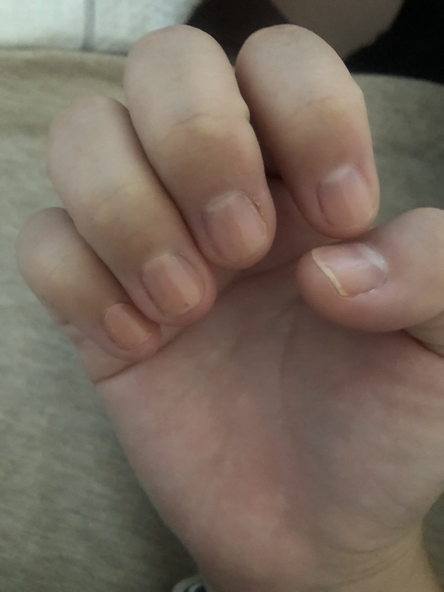 Pomu Beauty 今日の爪 少しずつ白い部分が伸びてきている トリートメントとか塗ってると噛むことない このまま育てえー 爪育成 深爪改善 Pomu Beauty 今日の爪 少しずつ白い部分が伸びてきている トリートメントとか塗ってると噛むことない このまま育てえー 爪育成 深爪改善