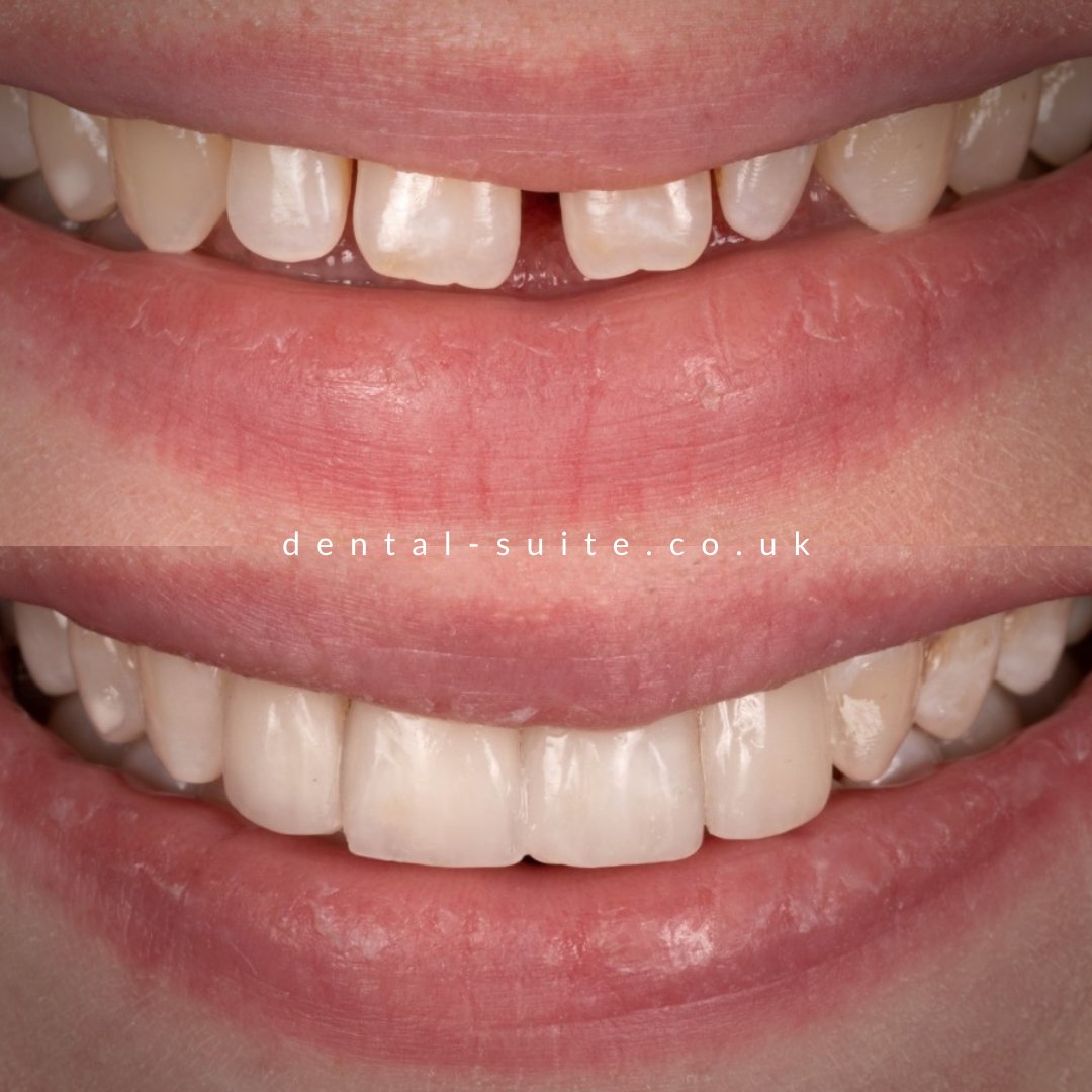 DentalSuite's tweet image. Tooth-gap closed in time for Christmas 🎅

The wonderful Dr Bernardo Caria treated this patient with composite bonding, leaving her with a smile makeover in time for the festivities.

Remember... this treatment takes a matter of hours, no teeth shaving &amp;amp; no pain 💡

#toothgap