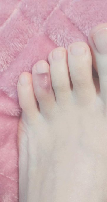 なかなかの色と腫れになってきた〜
起床3秒で足を強打すると一瞬で目が覚めるのでオススメです🤩 