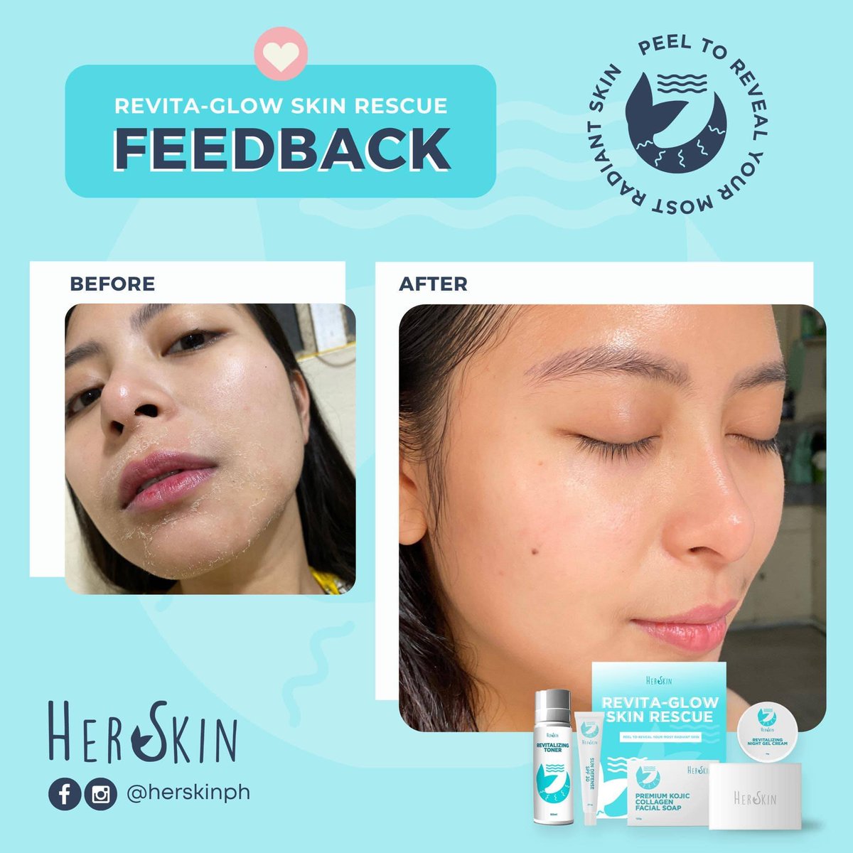 HerSkinPH__'s tweet photo. In behalf of KathRyee, I'am introducing Her Skin Revita-Glow Skin Rescue Kit. And you may get yours via Shopee for only ₱349.

https://t.co/yoaBEwQ0Nc https://t.co/xYo8Z3XEre