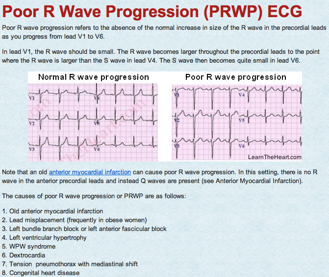 LearntheHeart's tweet photo. Poor R Wave Progression (PRWP)
R wave should become larger than S wave between V3-V4 ➔ if not then PRWP
#ECG https://t.co/UUYDLmpGVJ