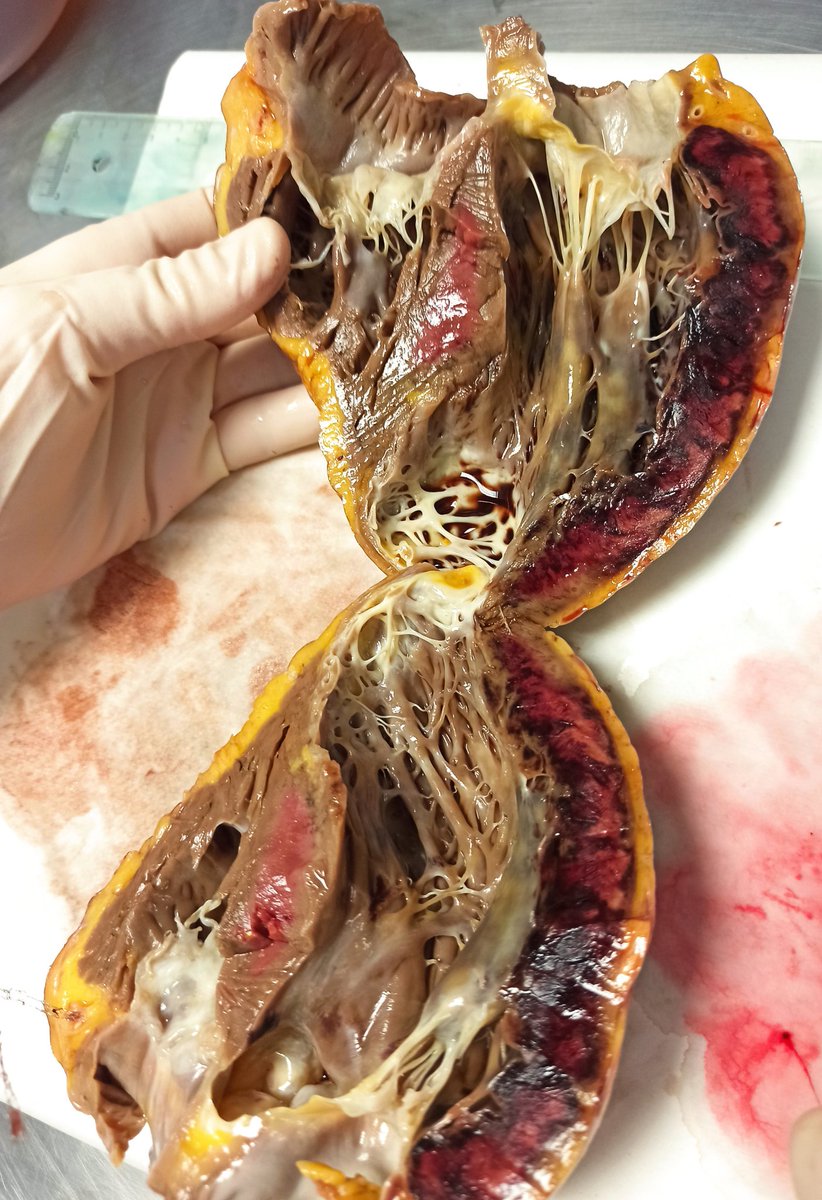 PatologiaH12O's tweet photo. Pieza de cardiectomía con infarto masivo en ventrículo izquierdo. https://t.co/na8fFWPa2d