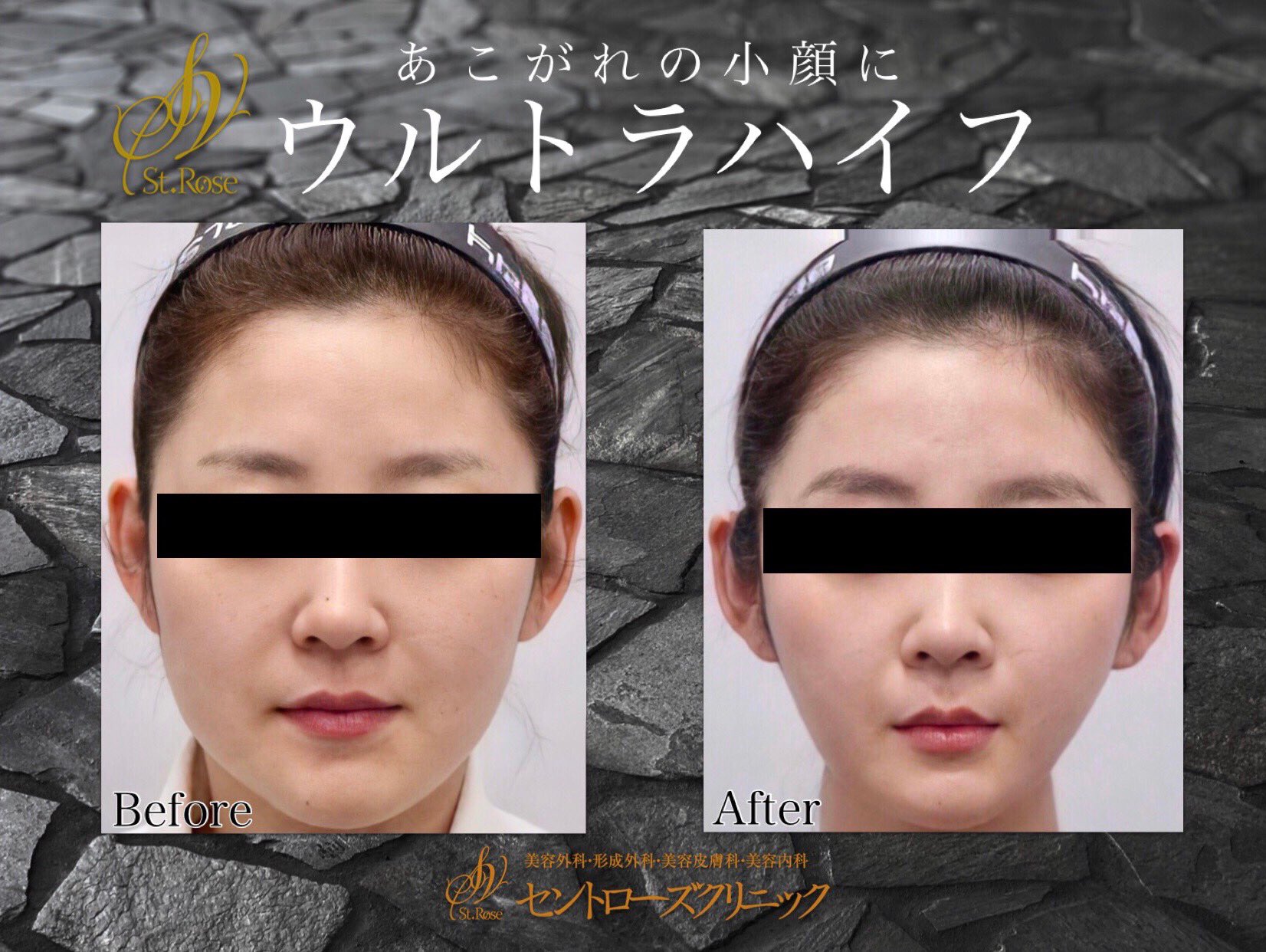セントローズクリニック 美容外科 美容皮膚科 在 Twitter 上 あこがれの小顔に 芸能人御用達の ウルトラハイフ 周囲に差をつけたいなら ハイフはマスト 始めるならキャンペーン中の今がおススメ T Co 2orvfz8jef ウルトラハイフ ハイフ