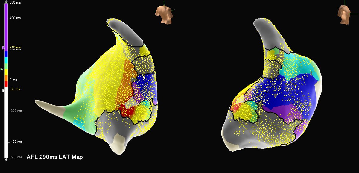 murphy_lzy's tweet photo. 20mins map with HD Grid, 32k+ points collected
extreme diseased atrium
tachy terminated within first ablation 
#AbbottEmp #HDGrid #Epeeps https://t.co/4dhmlX68ts