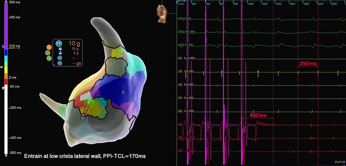 murphy_lzy's tweet photo. 20mins map with HD Grid, 32k+ points collected
extreme diseased atrium
tachy terminated within first ablation 
#AbbottEmp #HDGrid #Epeeps https://t.co/4dhmlX68ts