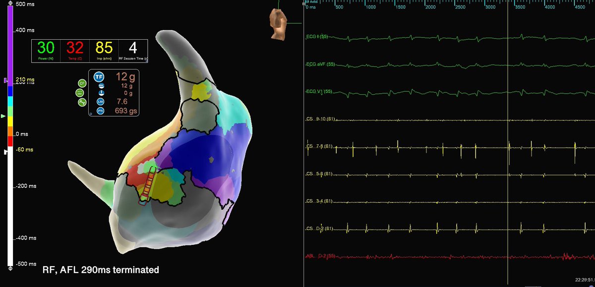 murphy_lzy's tweet photo. 20mins map with HD Grid, 32k+ points collected
extreme diseased atrium
tachy terminated within first ablation 
#AbbottEmp #HDGrid #Epeeps https://t.co/4dhmlX68ts