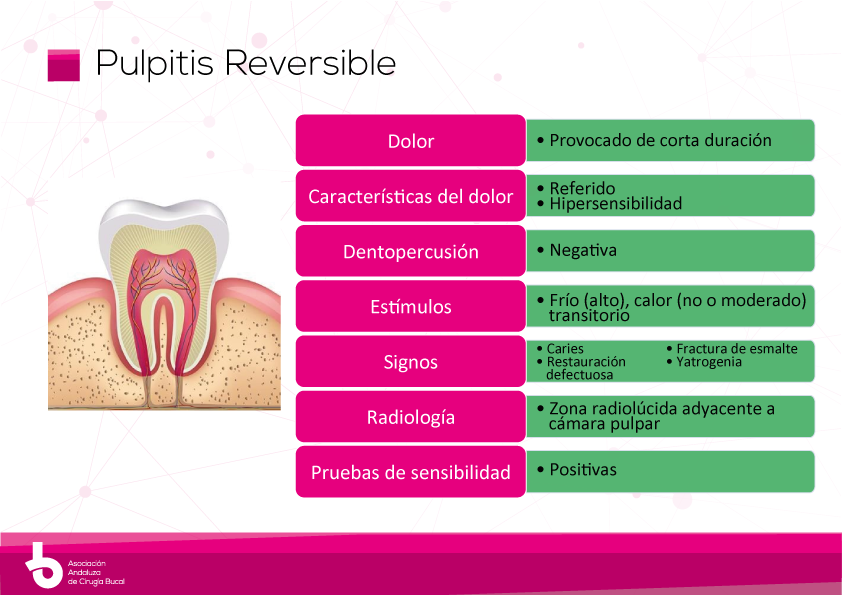 aacibandalucia's tweet image. Con esta #infografía te mostramos los rasgos más significativos de la #pulpitis reversible.
#odontología #CirugiaBucal #SaludDental