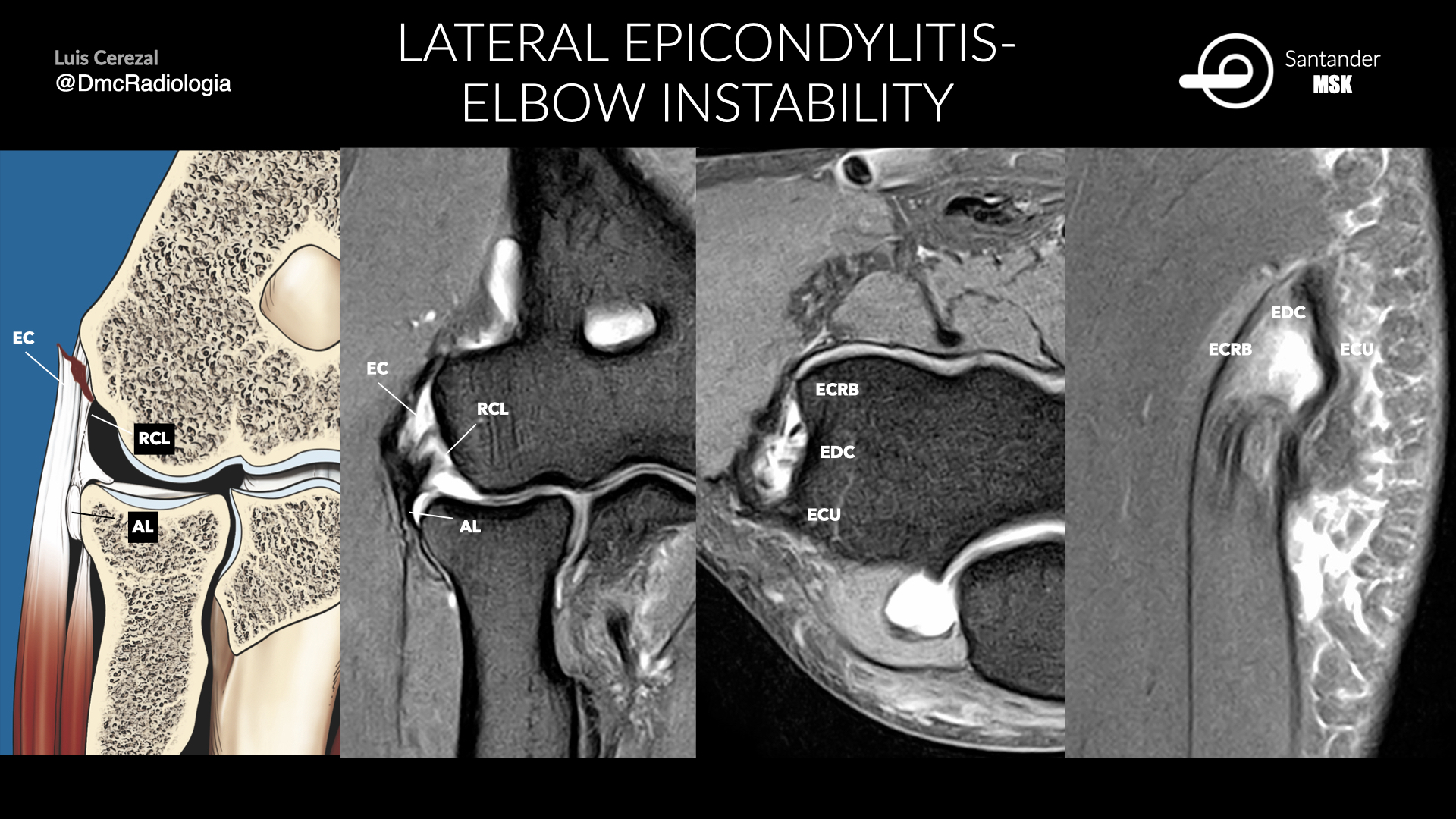 Lateral Epicondylitis Mri