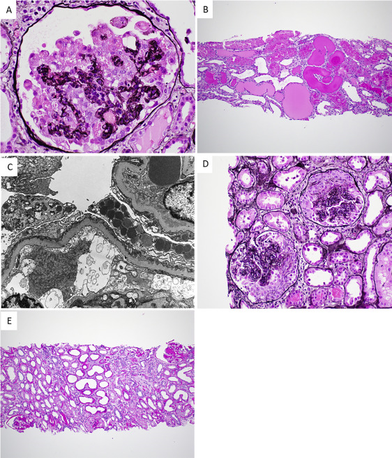 MayoClinicNeph's tweet photo. Kidney Biopsy Findings in Patients With COVID-19, Kidney Injury, and Proteinuria @MPAlexanderMD @ldcornell @SethiRenalPath @renalpathdoc #MayoClinicKidney
https://t.co/ji6DdWGylF https://t.co/17gmKxxC0D