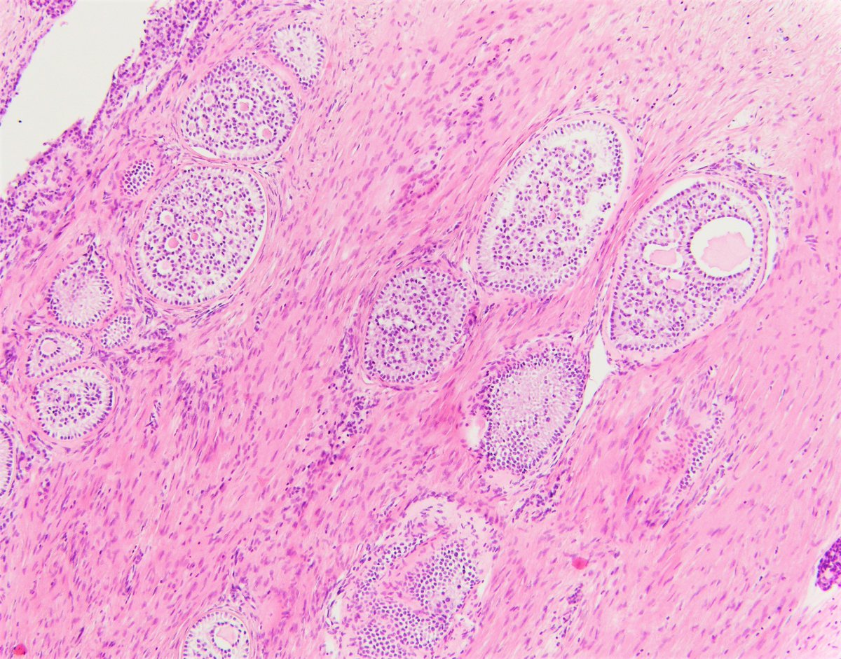 BWHPath's tweet photo. What do you think of these bilateral ovarian masses in a young female? What is the associated syndrome? Is the prognosis different between syndromic and non-syndromic cases?
#BWHPathCoTW #pathology #GynPath #PediPath 1/ https://t.co/hrCukXEFQV