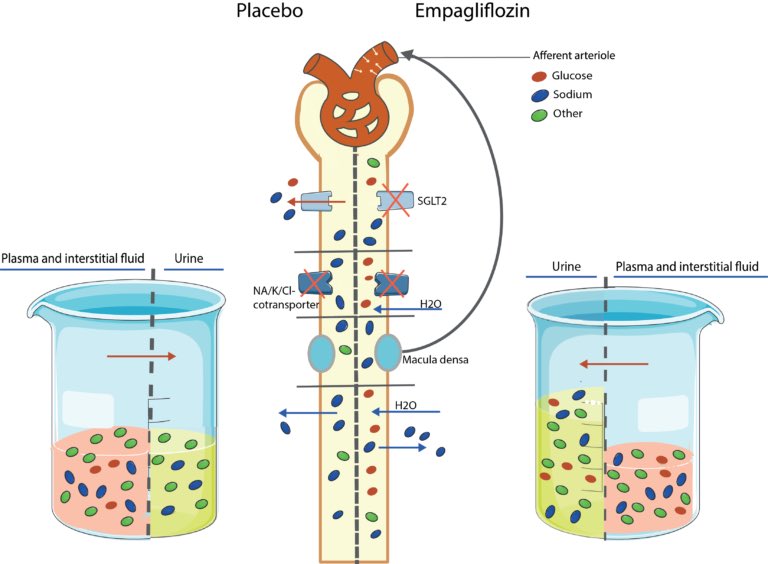 Our data suggests that ✅ empagliflozin stimulates osmotic diuresis through increased glucosuria rather than natriuresis in acute HF patients. The intrigue of #SGLT2i continues, demonstrating suitability as an add-on therapy to diuretics in acute HF ✨