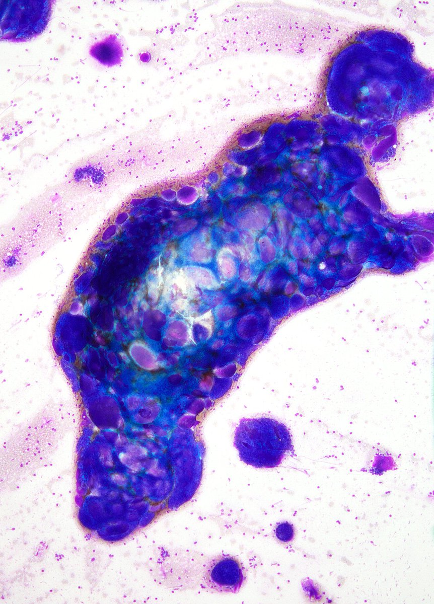 sza_jhcyto's tweet photo. "An Impressive Jackpot of Hyaline Balls". Adenoid Cystic Carcinoma, Submandibular Gland FNA. https://t.co/xdzUCFiwp0