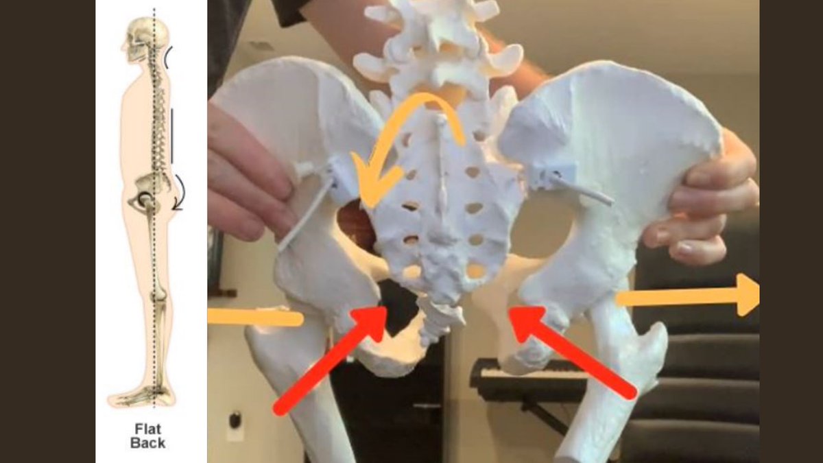 The reason why I sometimes don’t target the glutes first is because the glutes can actually be overly tight in someone with missing hip extension.In this case, you’ll see them “butt gripping” where their glutes are always tight and trying to restrict their pelvis from