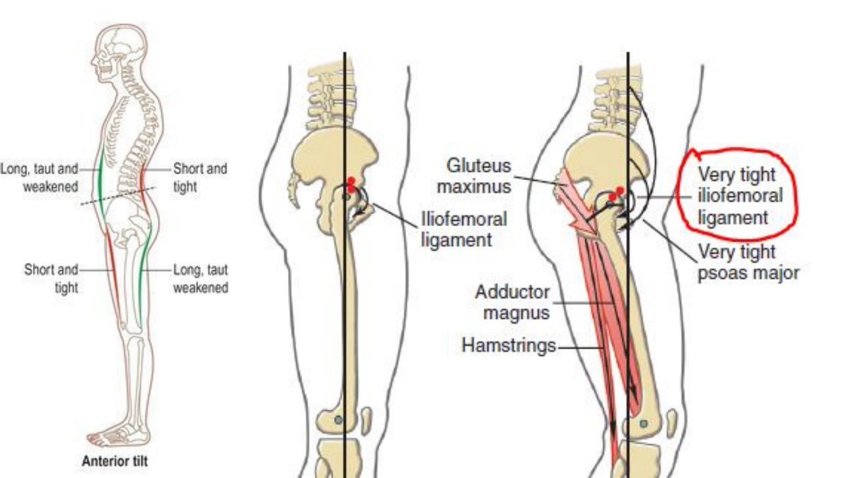 You’ll commonly see people who don’t have full hip extension stand in an Anterior Pelvic Tilt.I think we know this tightens the hip flexors and back extensors, but it also tightens & restricts ligaments of the hips like the iliofemoral ligament.This creates a hip flexion