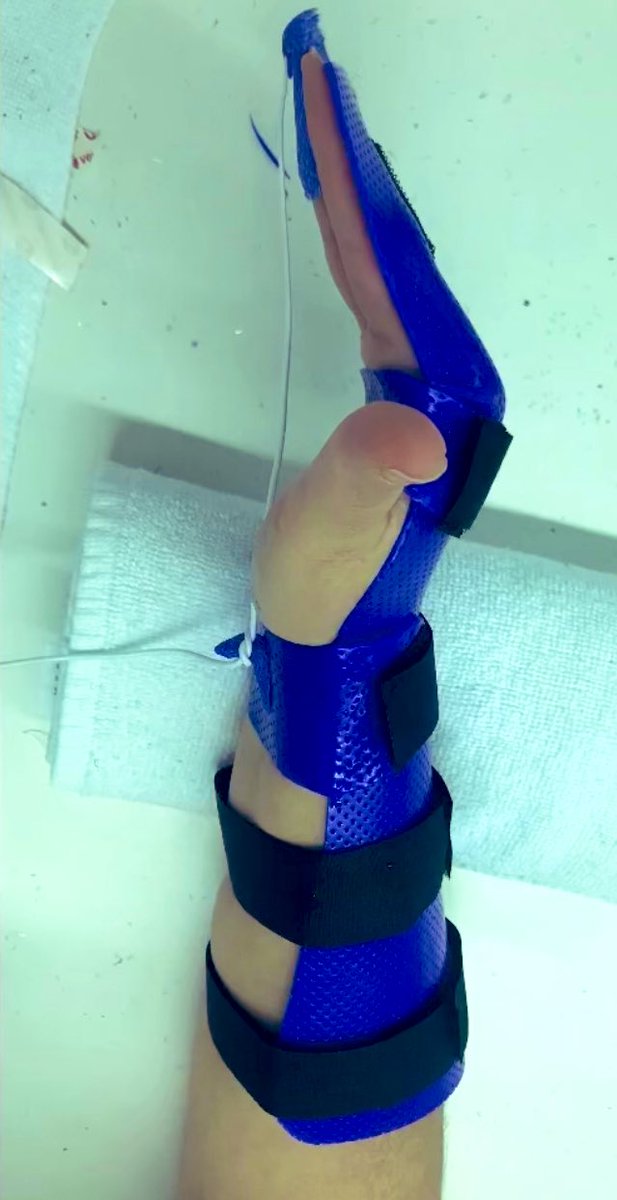jonas_handOT's tweet photo. Férula dinámica Kleinert! #feruleando #splint #tendonrepair #flexors https://t.co/J71jabo369
