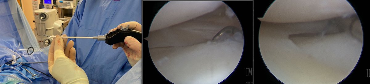 djvcity's tweet photo. 🔥HOT OFF THE PRESS!🔥
Thanks to the #innovators at @Arthrex for the new #reversecurve and #24 degree curve #fiberstitch implants - had the opportunity to be one of the 1st to use these today in the care of my #patients / #athletes
Nice versatility -- get it where you need it! https://t.co/VZsmREDXJ3