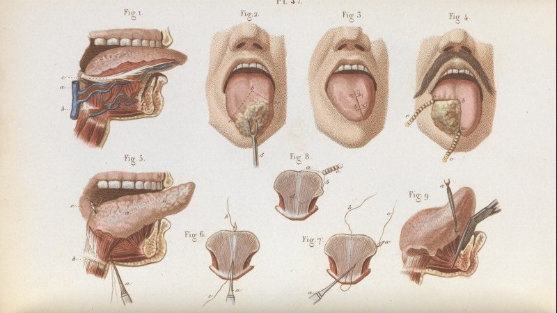 I argue that cancer's incurability prompted the development of a kind of palliative surgery, one that sought to alleviate suffering rather than 'cure'. I also suggest that the peculiarities of  #TheCancerProblem redrew the boundaries between orthodoxy and quackery