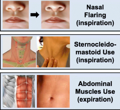 7/So things to always be vigilant about:Your patient’s oxygenation (O2 sat)Their work of breathing (are they getting tired? see pic!)Hemodynamics (BP, HR)Rashes/labs that could mean thrombosisAnd ALWAYS listen to your nurses. If they’re worried, you should be too.