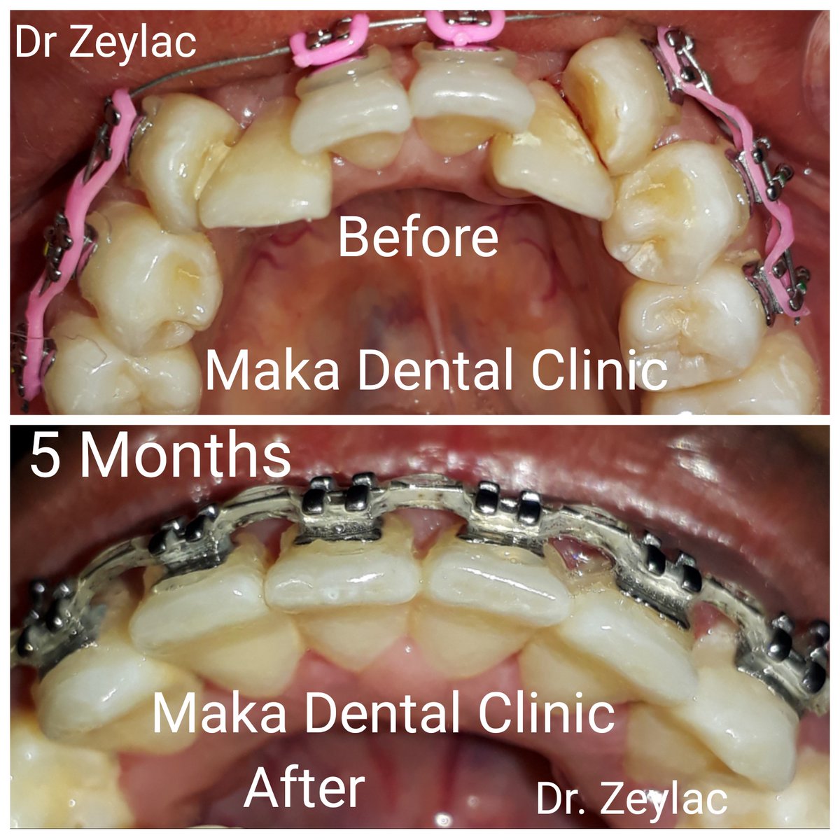 MAKADENTALCLIN1's tweet photo. Isbedel lahubo, Qiimo macquul ah aadna kiskis iskaga bixinkartid intaba ugu kaalay Xarunta Casriga ah ee Maka Dental Clinic
Whatsp: +252615512168   +252615123993  +252616573027 https://t.co/PLb6B38owk