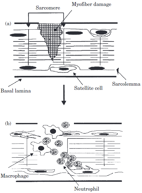 8/Myotrauma releases Damage Associated Molecular Patterns (DAMPs).DAMPs recruit macrophages, neutrophils, and lymphocytes into the recently-exercised muscle. Associated prostaglandin release and vasodilation causes delayed muscular swelling. https://pubmed.ncbi.nlm.nih.gov/10805959/ 