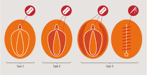 5/9 #Obstetricfistulae are especially common in  #women who give birth very young, women who have experienced malnourishment & women who have experienced  #FGM ( #Female Genital Mutilation/Cutting).  #IrishWomenInHistory  #NollaigNamBan  #EndFGM  #WomensHealth