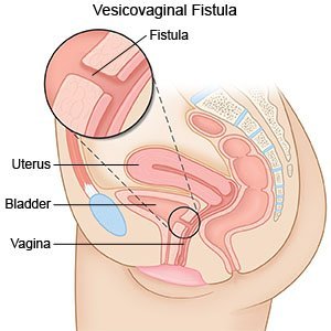 4/9An obstetric fistula is a complication of childbirth when the birth canal, the vagina, is injured so badly that a hole develops between the vagina & the rectum &/or the bladder, leading to problems such as incontinence, chronic pain, mental illness, social isolation, & more.