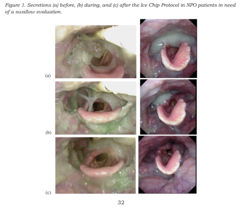 94/#365papers Ice chips don’t seem to be as much of a thing here as in the US but this was still a worthwhile read. The images of pharyngeal secretions before/after ice chip trials are a great illustration of some of the risks of recommending NBM without sips of water 🤢