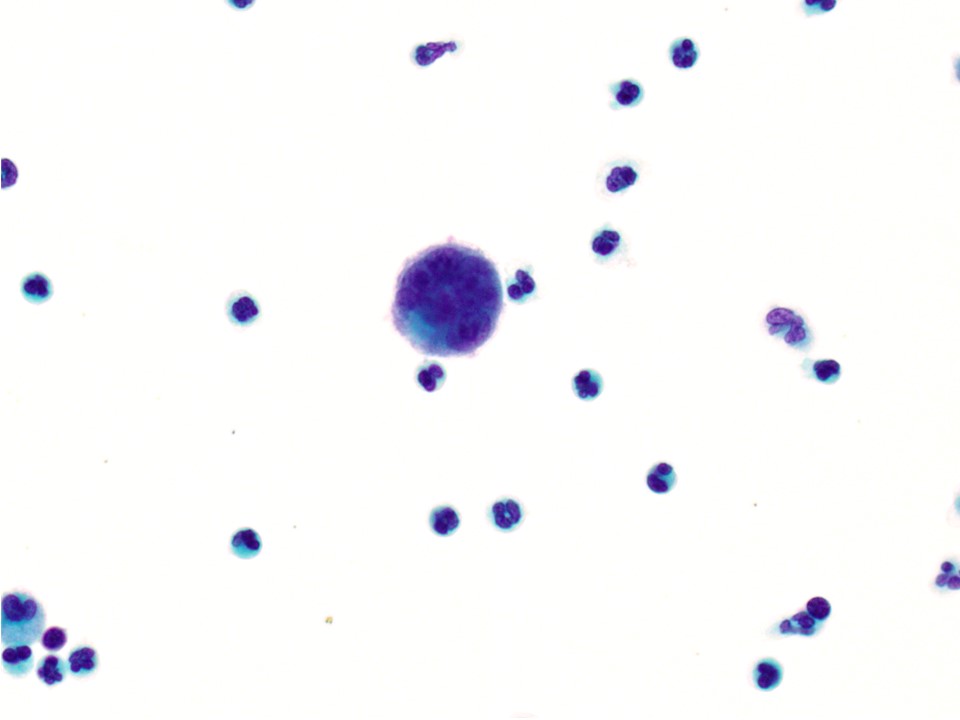 VandaTorousMD's tweet photo. Pleural fluid w large scattered multinucleated cells:

Extramedullary hematopoiesis- megakaryocytes highlighted by CD61

Pt w hx of myelofibrosis. Dont forget to keep EMH on ur ddx. Most common sites r spleen/liver but pleura/other organs can be involved

#cytopath #PathTwitter https://t.co/p3iBOAG8nI