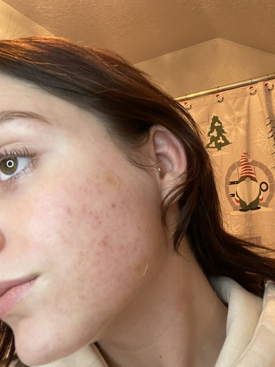 saltygoob's tweet photo. almost a year apart. no where near perfect yet but i only have two active breakouts ! and its so smooth now im happy ((: https://t.co/cuEF5o6yXa