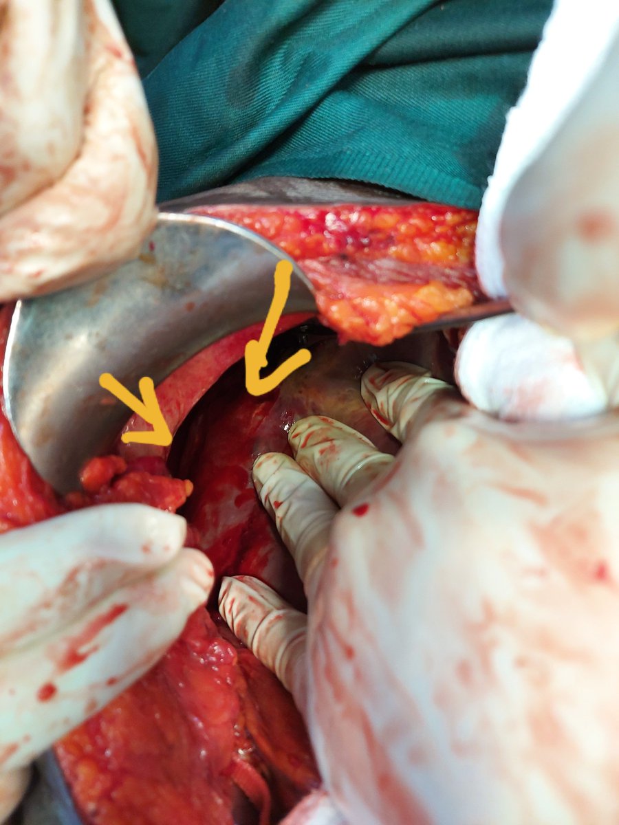 xsurgeon3's tweet photo. Blunt abdominal trauma, Liver injury Grade III, between liver segment VII and VIII, damage control surgery(DCS) were performed(packing). Indications to do DCS?@efsthsurgery, @lvazxman, @anniaramosperez, @DrKebsun,@DrJaiteh,@pasohna,@LaminOBeyai,@Fantitafofana,@bigboydarboe https://t.co/K6xWeS5KQ8