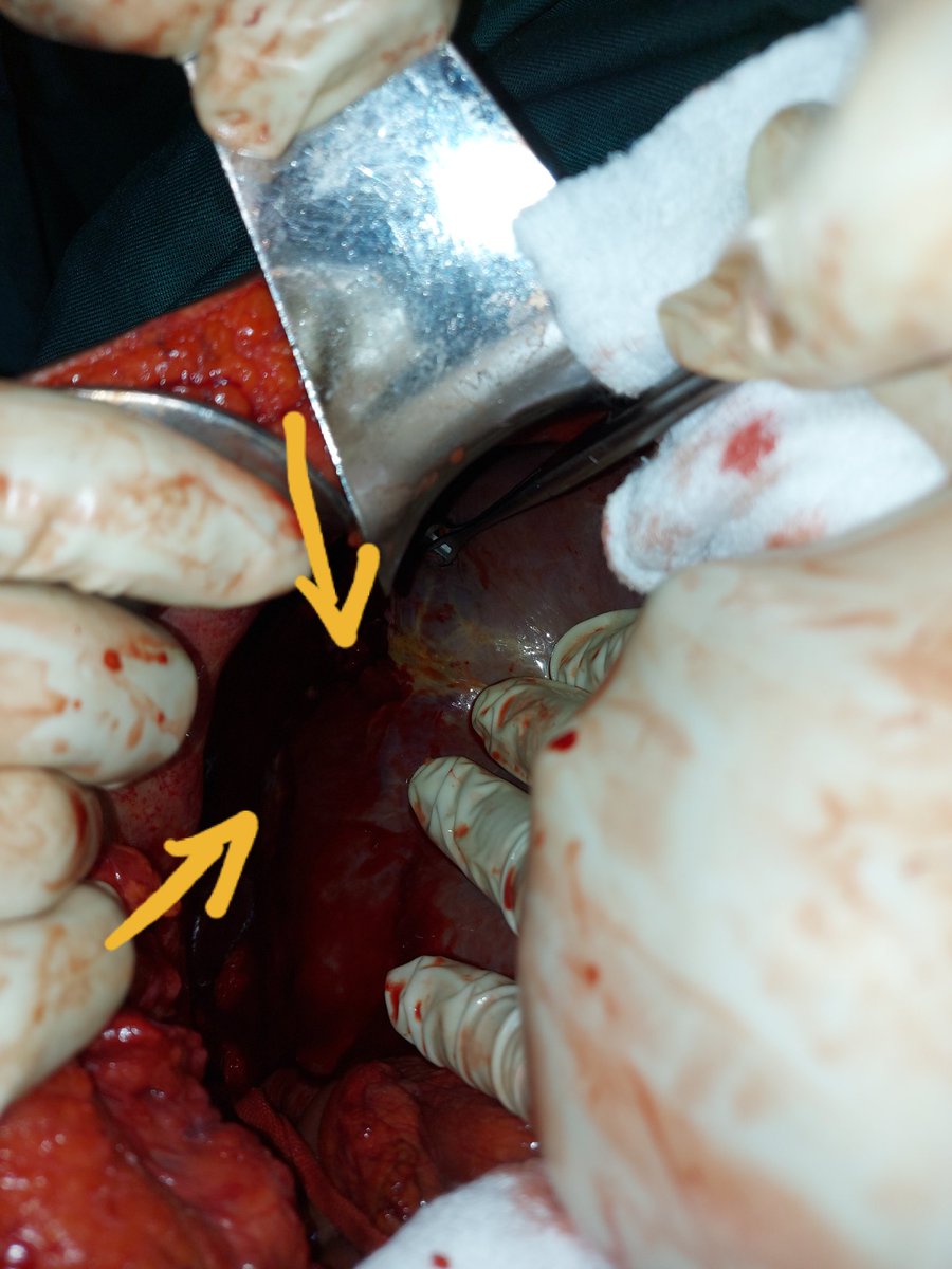 xsurgeon3's tweet photo. Blunt abdominal trauma, Liver injury Grade III, between liver segment VII and VIII, damage control surgery(DCS) were performed(packing). Indications to do DCS?@efsthsurgery, @lvazxman, @anniaramosperez, @DrKebsun,@DrJaiteh,@pasohna,@LaminOBeyai,@Fantitafofana,@bigboydarboe https://t.co/K6xWeS5KQ8