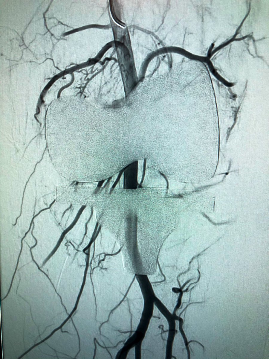 Always great collaborating with my old #orthotwitter crew: recurrent pain &amp; hemearthrosis s/p L TKA. Angio shows hyperemic synovium, lat&gt;med w/ resolution post selective genicular artery embolization w/ <a href="/MeritMedical/">Merit Medical</a> Embospheres. No more opioids, no revision. @rads99md <a href="/mms62786/">Mustafa Syed</a>