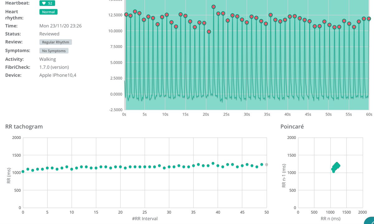 Dominik Linz (@dominik_linz) on Twitter photo OK, let's start...
Example 1
-Regular intervals between the PPG-signal
-1 dense cloud in Poincare plot
-Note some respiratory sinus arrhythmia resulting in an oval point cloud
This PPG recording was likely recorded during sinus rhythm
4/5
<a href="/DhirajGuptaBHRS/">Prof Dhiraj Gupta</a> <a href="/DavidDuncker/">David Duncker</a> OK, let's start...
Example 1
-Regular intervals between the PPG-signal
-1 dense cloud in Poincare plot
-Note some respiratory sinus arrhythmia resulting in an oval point cloud
This PPG recording was likely recorded during sinus rhythm
4/5
<a href="/DhirajGuptaBHRS/">Prof Dhiraj Gupta</a> <a href="/DavidDuncker/">David Duncker</a>