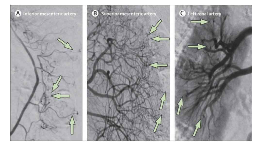 Volvemos con otra imagen clínica. 

🧔🏻 59 años 15 días de:

🤒 Fiebre 😥 cefalea  y mialgias  ⬇️ peso de 4kg.
📝PCR 16 mg/dL. Sin leucos. 
☢️PET: captación pared pequeñas y medianas arterias.

Se hizo la arteriografía de la foto.

¿Sospecha diagnóstica?