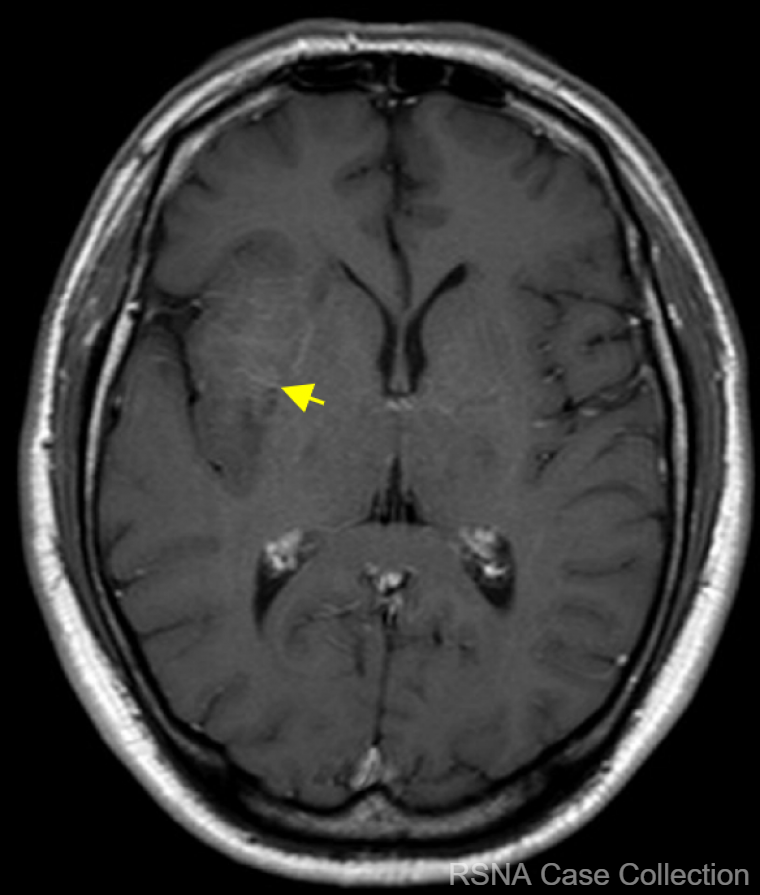 This #RSNACC Case of the week may “blow your mind”! What’s the diagnosis in this 56 yo with new onset of partial left motor seizures? bit.ly/2Jxe2dg 

@RSNA @TheASNR @theASFNR @TheAJNR @uOttawaRad @CARadiologists @JNeuroradiology @ESNRad 

#NeuroRad #RadEd #brainimaging