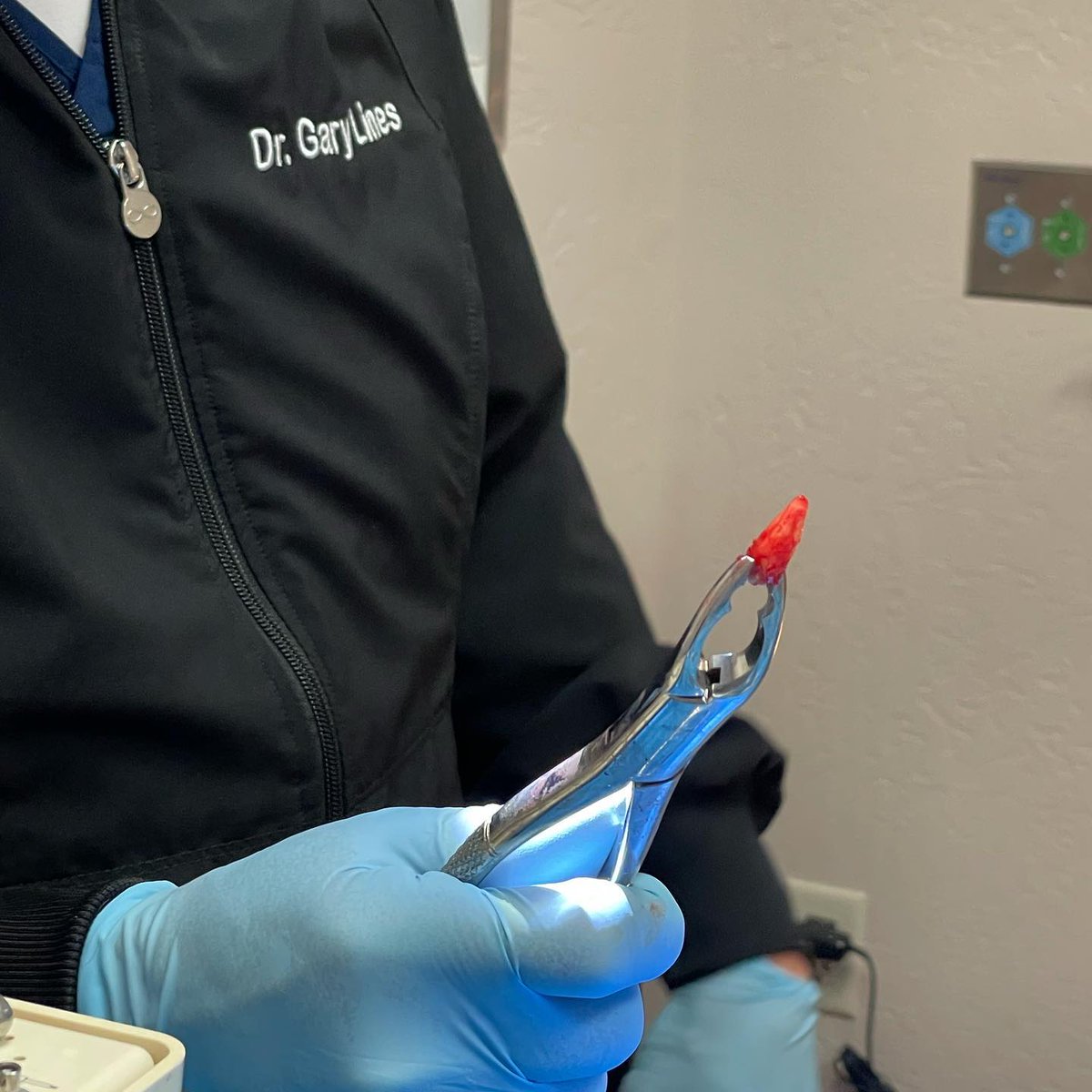 azctr4implants's tweet image. A patient came in with a #fronttooth that was broken at the gum line, needed an extraction, and #immediateimplant. Here’s the smile before and the root that was extracted. We can’t wait to see his recovery and final crown in the near future 😁
.
#azctr4implants #dentalimplants