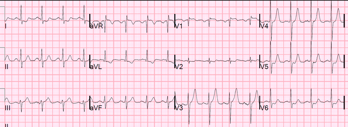 smithECGBlog's tweet photo. ECG with Aslanger's Pattern. CT Pulmonary Angiogram Reveals LAD Ischemia (Septal Transmural). But this is not Contradictory.
https://t.co/qMNm9dvlHc https://t.co/gGV8uttcXa