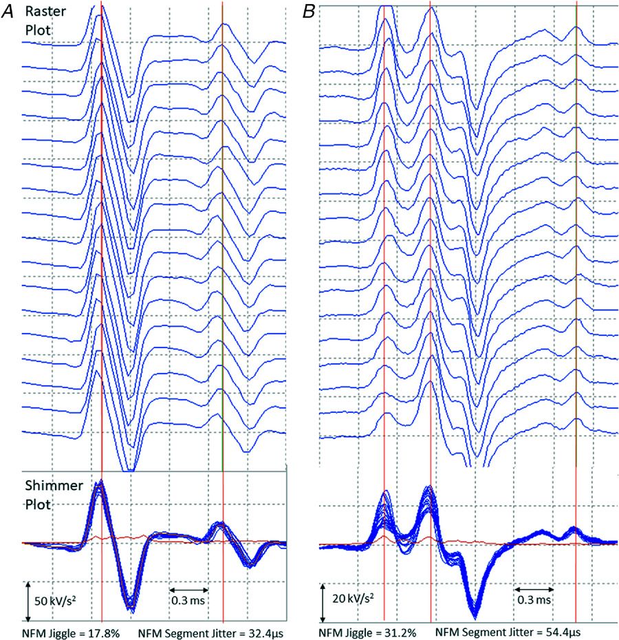 JPhysiol's tweet image. Are masters athletes more successful at #motorunit remodelling? Are there sex differences in motor unit remodelling? Intriguing new research by @MathewPiasecki @NottmBRCMSK @MedicineUoN 👉 buff.ly/3n57kJg