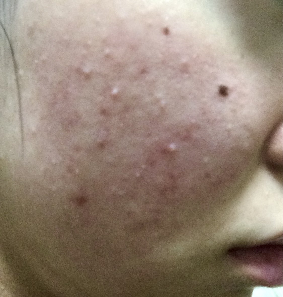 中山 リナ 10代の頃 何度も悩まされた赤みとニキビの肌荒れ 何度も戦ってきて ホルモンも落ち着いてきたタイミングもあり ファンデ卒業 今はシカペア リカバーとベビーパウダーのみ でも まだ頬の中心にある赤みはいまだに健在 それでもマシになっ