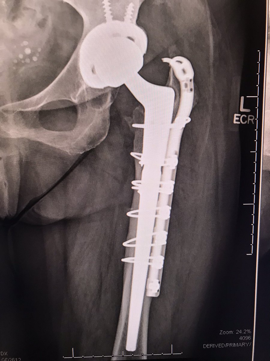 When a patient presents to the clinic w/this X-ray. That cup should be easy to remove. Anyone else ever see that stem fracture like that? Had to ETO to get it out.