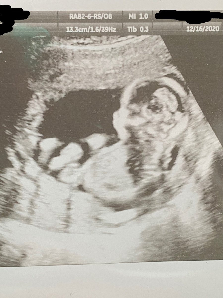 YCrackin's tweet image. Y’all! I’m going to be a Grammy!!!!!Meet Baby Girl Jellybean due June 7, 2021!