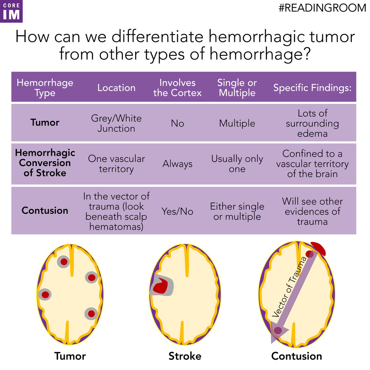 3/ In describing the bleed in the previous tweet, we hinted at the differential for a brain bleed. The table below summarizes that differential and the distinguishing characteristics of each type of hemorrhage.