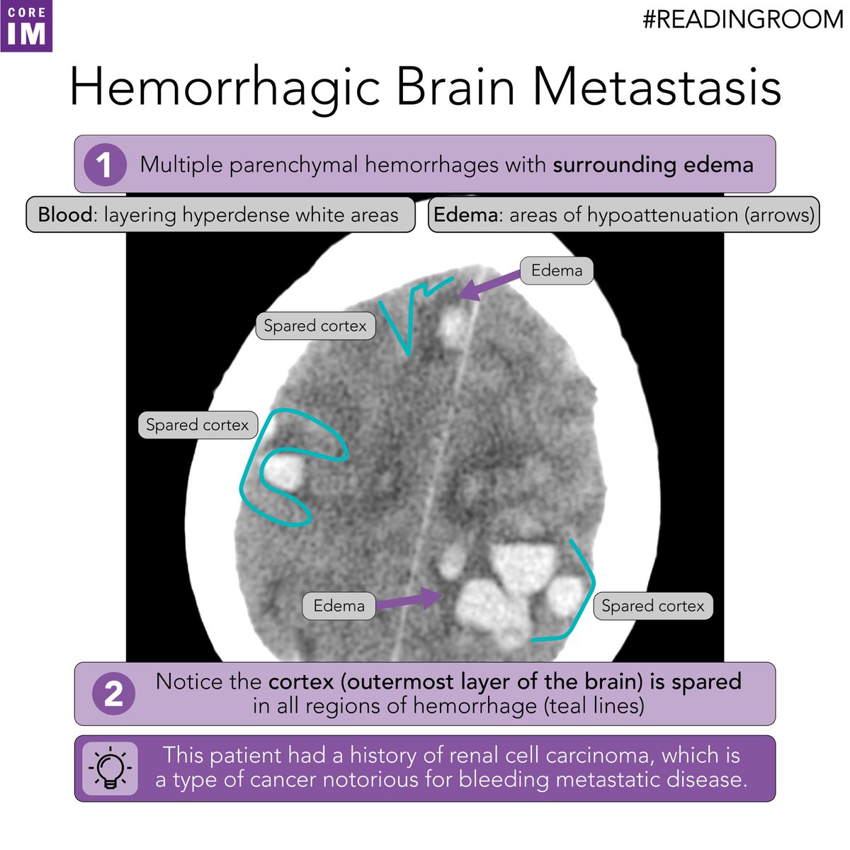 2/ You’ve got multiple sites of bleeding in the brain. No signs of trauma. Doesn’t follow a vascular territory. The bleed spares the cortex, and each hemorrhage is surrounded by edema. This is the classic and unfortunate appearance of hemorrhagic brain mets.