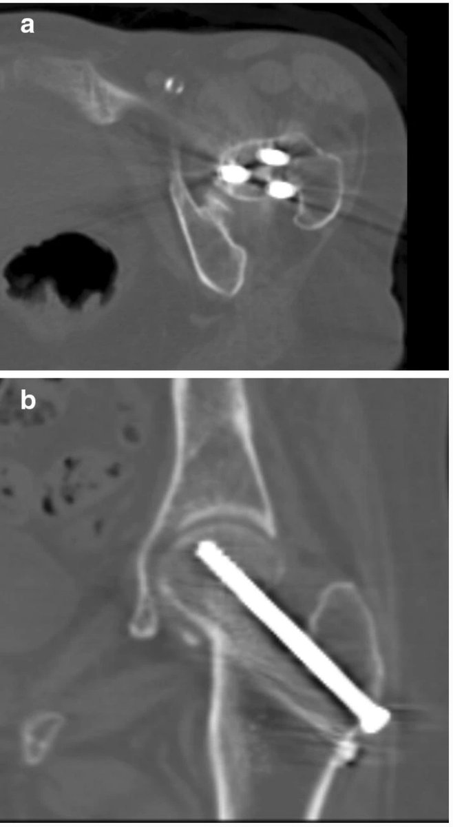 Interesting throwback! Check out this article! ‘High incidence of “in–out–in” posterosuperior screws after cannulated screw fixation of femoral neck fractures.’ 

What’s your incidence of “in-out-in”? Comment below!
link.springer.com/article/10.100…